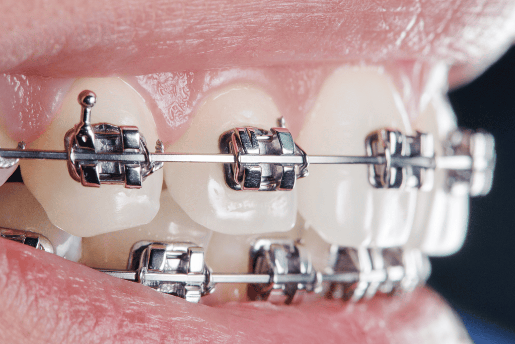 Dental braces