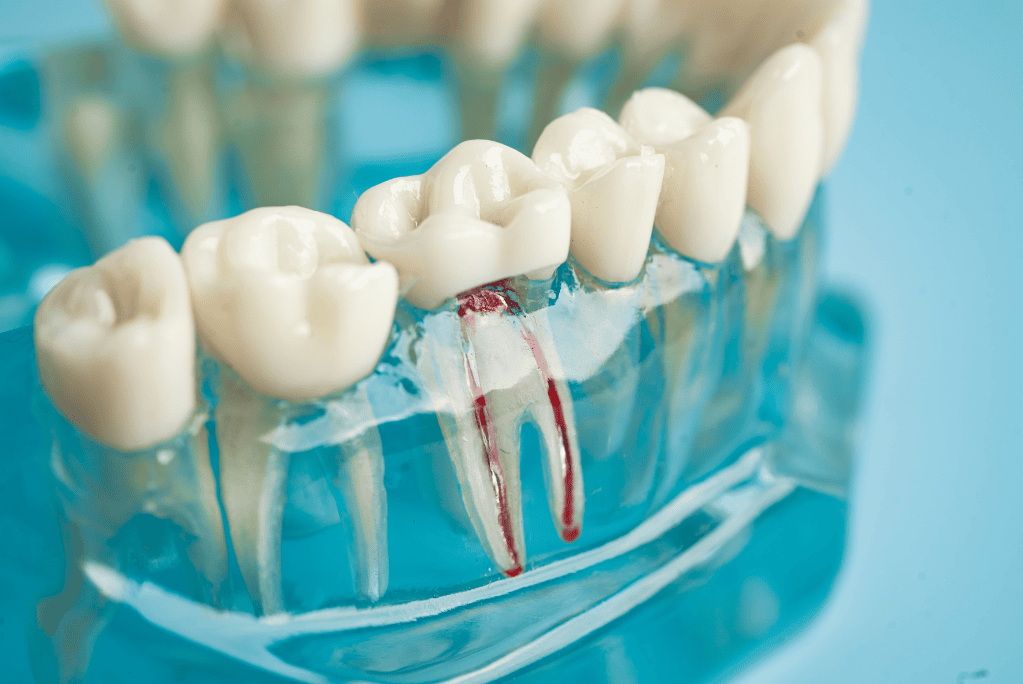 Root Canal Cost in Kochi