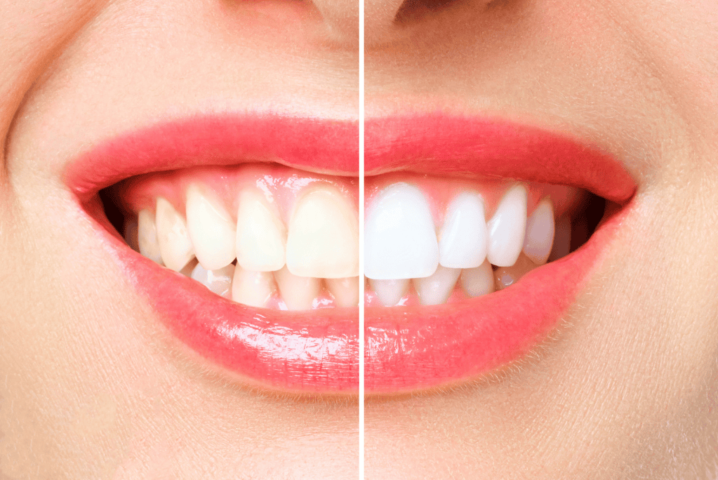 Teeth whitening