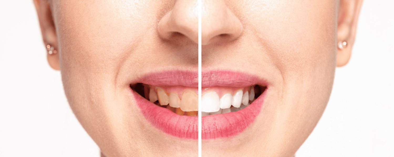Teeth Whitening