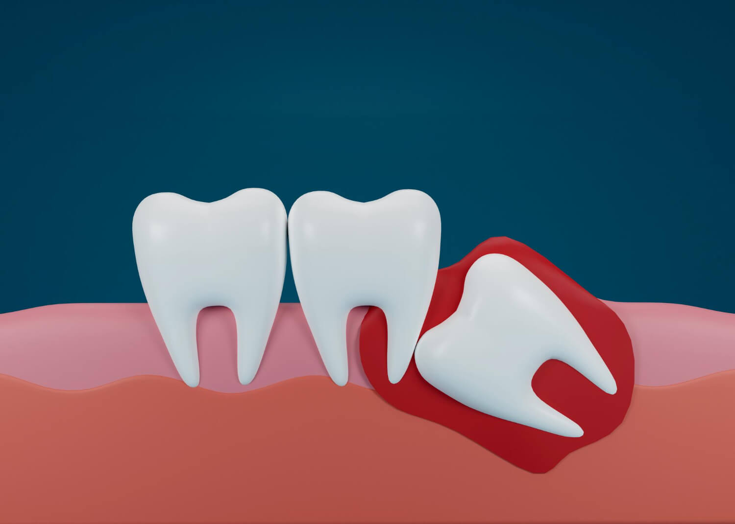 Wisdom Tooth Removal in Kochi