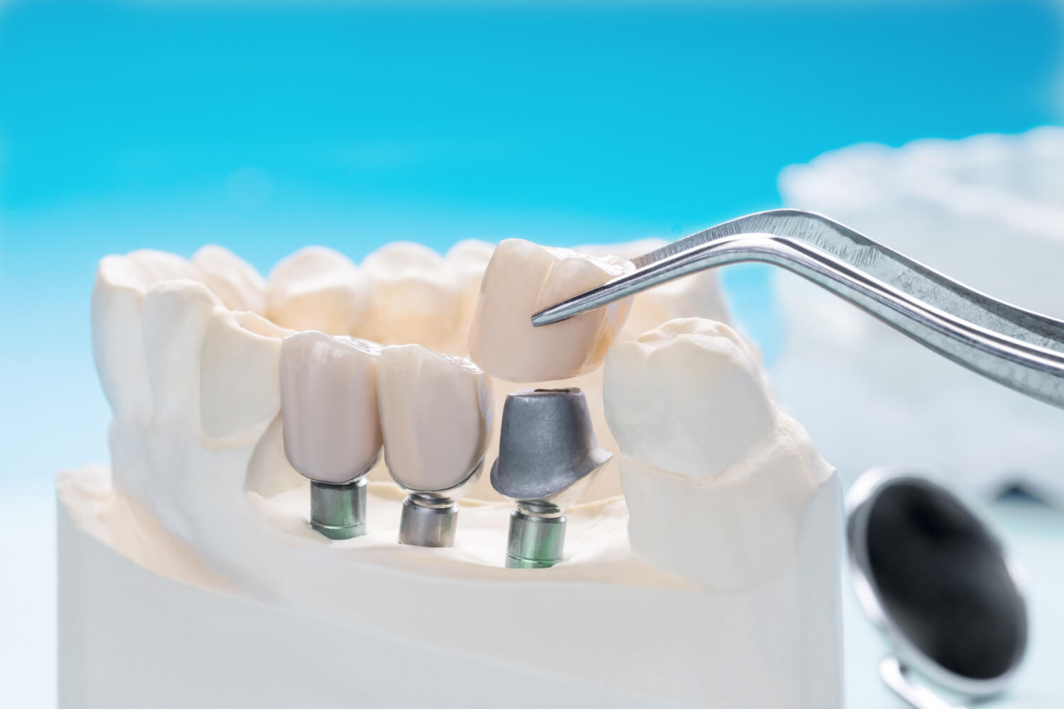 Best clinic for dental crowns and bridges in Kochi