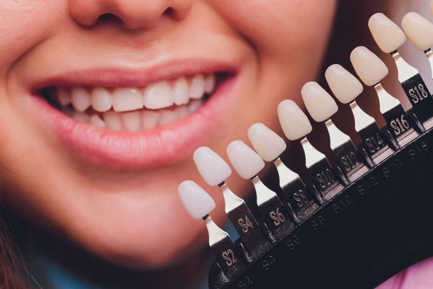 Laminate Veneers in Kochi