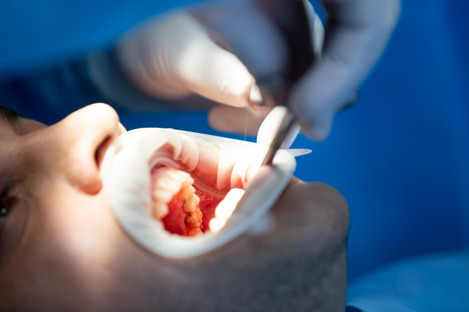 Painless Root Canal Treatment in Kochi