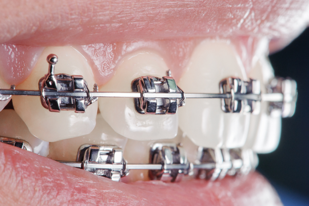 Dental braces