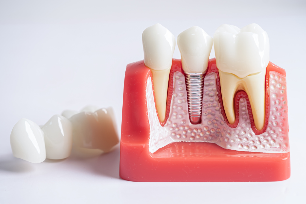 Is Root Canal Treatment Painful