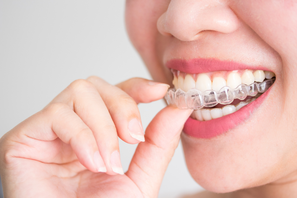 Best Invisalign Treatment in Kochi