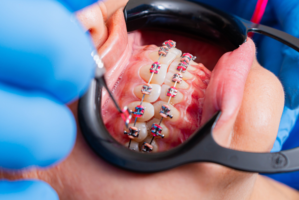 Best Orthodontist in Kochi