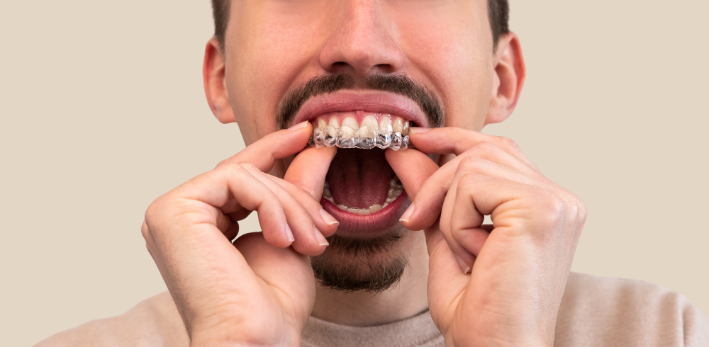 How Long Does Invisalign Treatment Take
