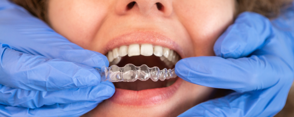 Invisalign Treatment