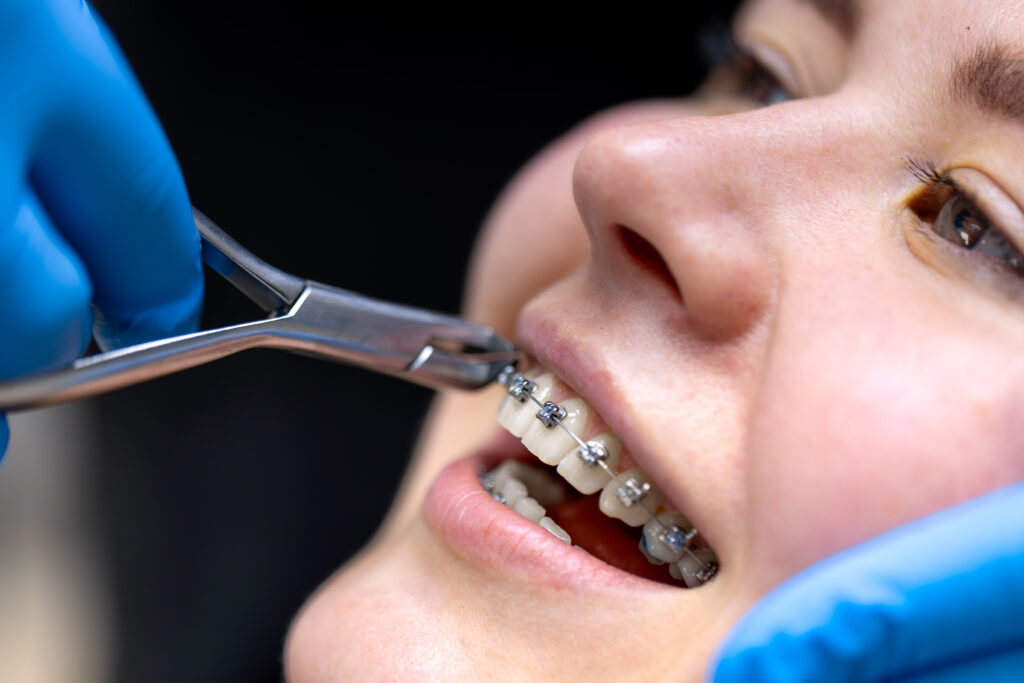 Best Braces Treatment in Kochi